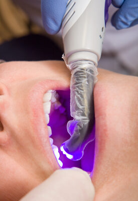 How to Make Sure You Care for Composite Fillings Properly