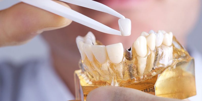 Health Benefits Of Dental Implants