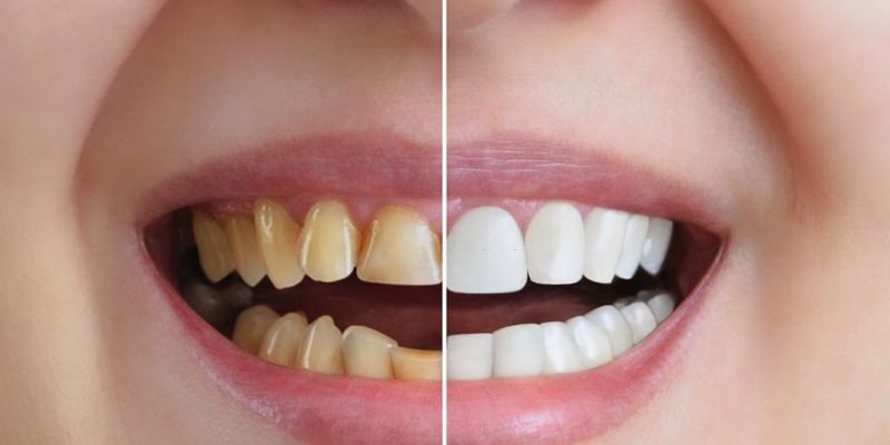 Real-Life Cosmetic Dentistry Transformations