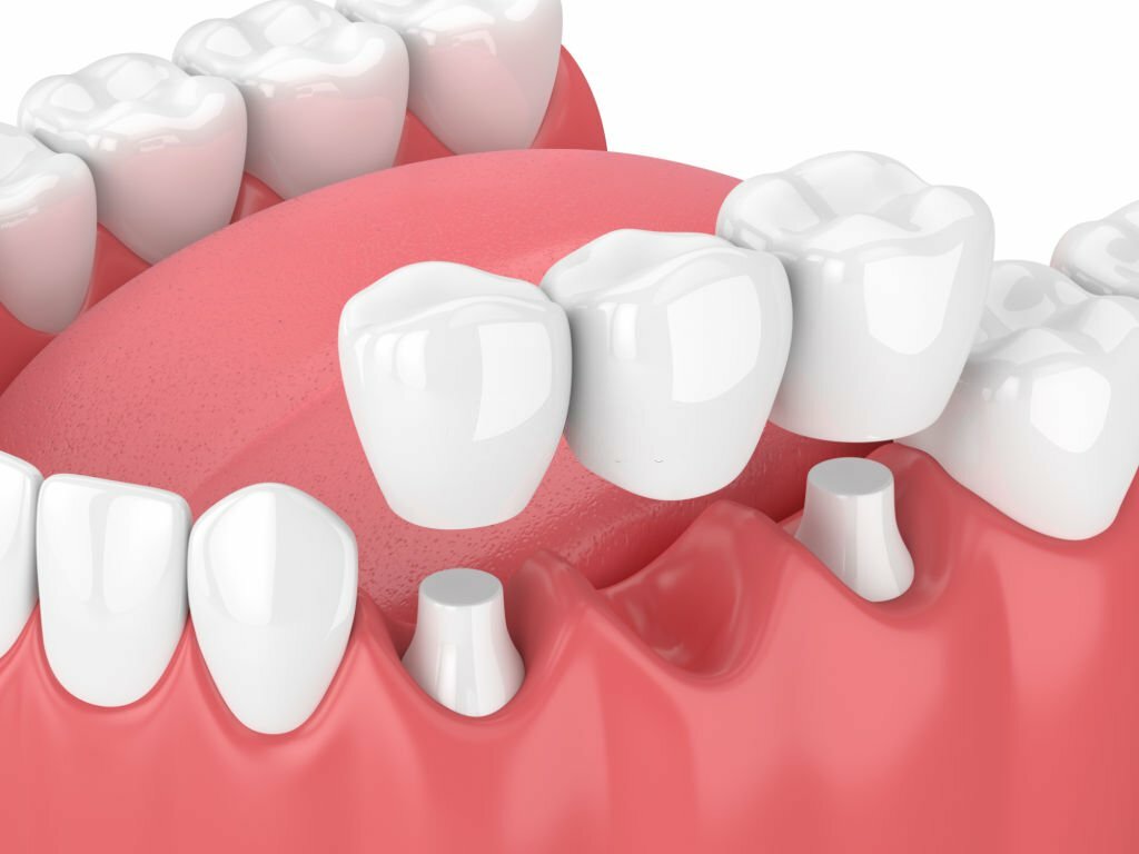 Dental Implants_1