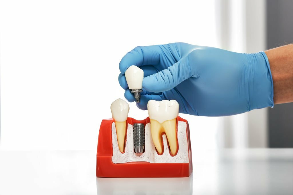 Dental Implants Procedure