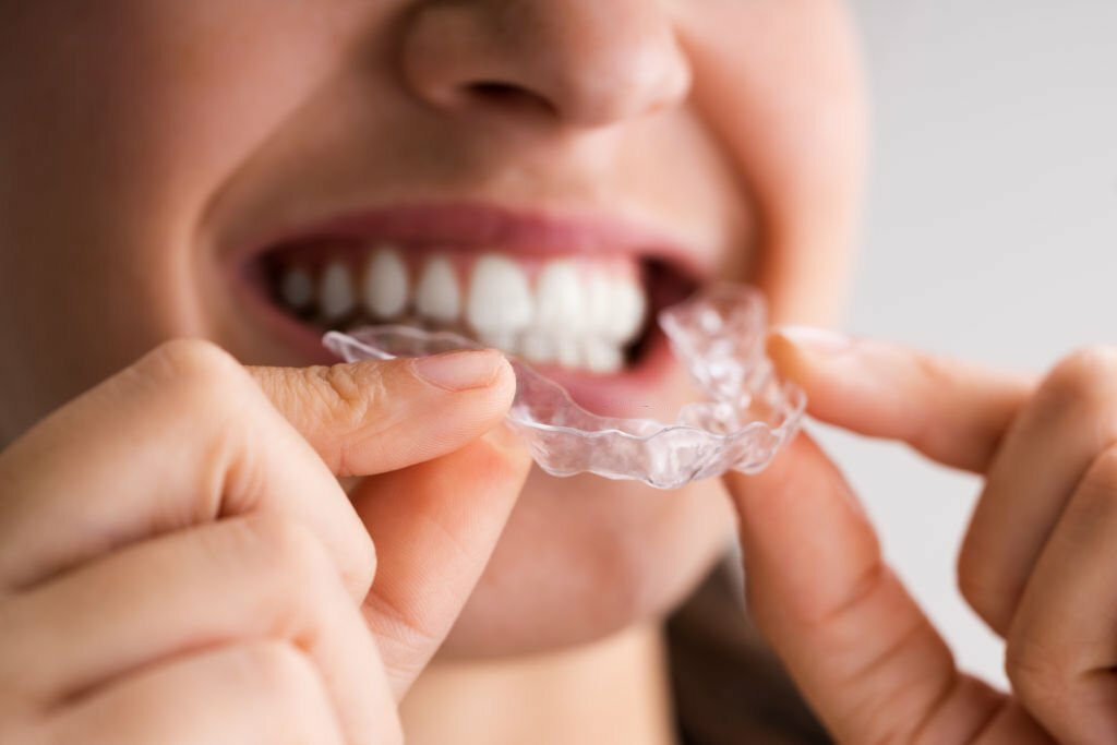 Invisalign Braces