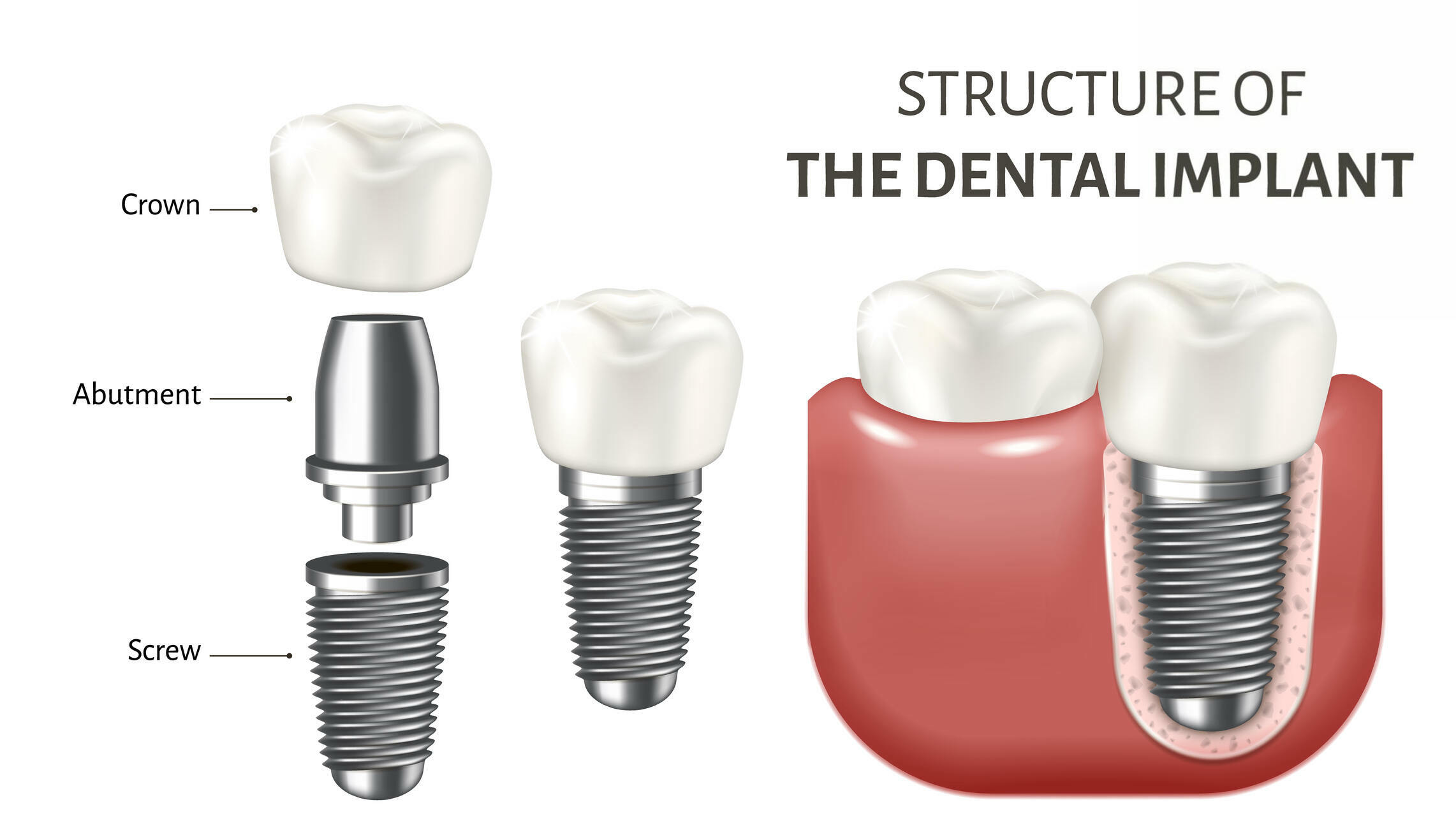 Implant Dentistry By Cosmetic Dentist in Gallup, NM: Everything You Need to Know!_2