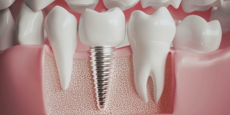 Implant Dentistry By Cosmetic Dentist in Gallup, NM: Everything You Need to Know!_FI