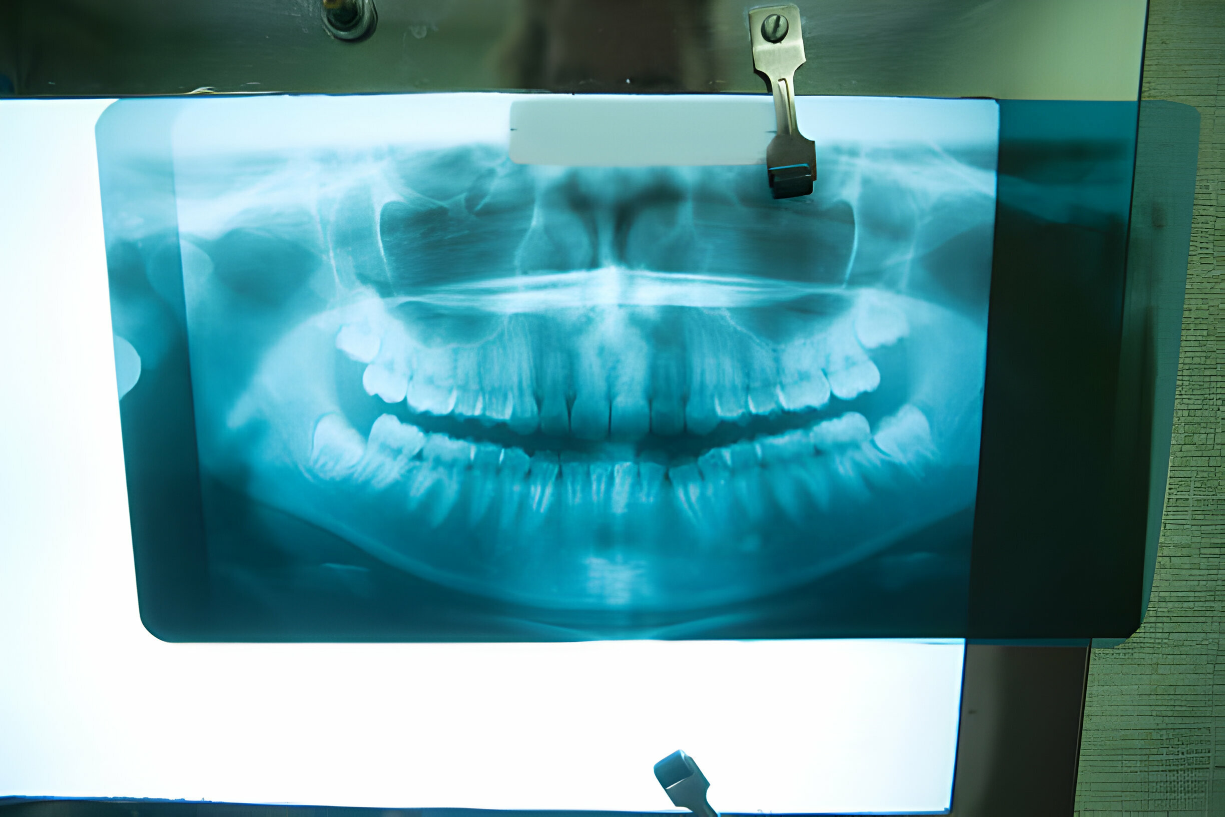 Different Types of X-Rays by Dental Summerville, SC_1