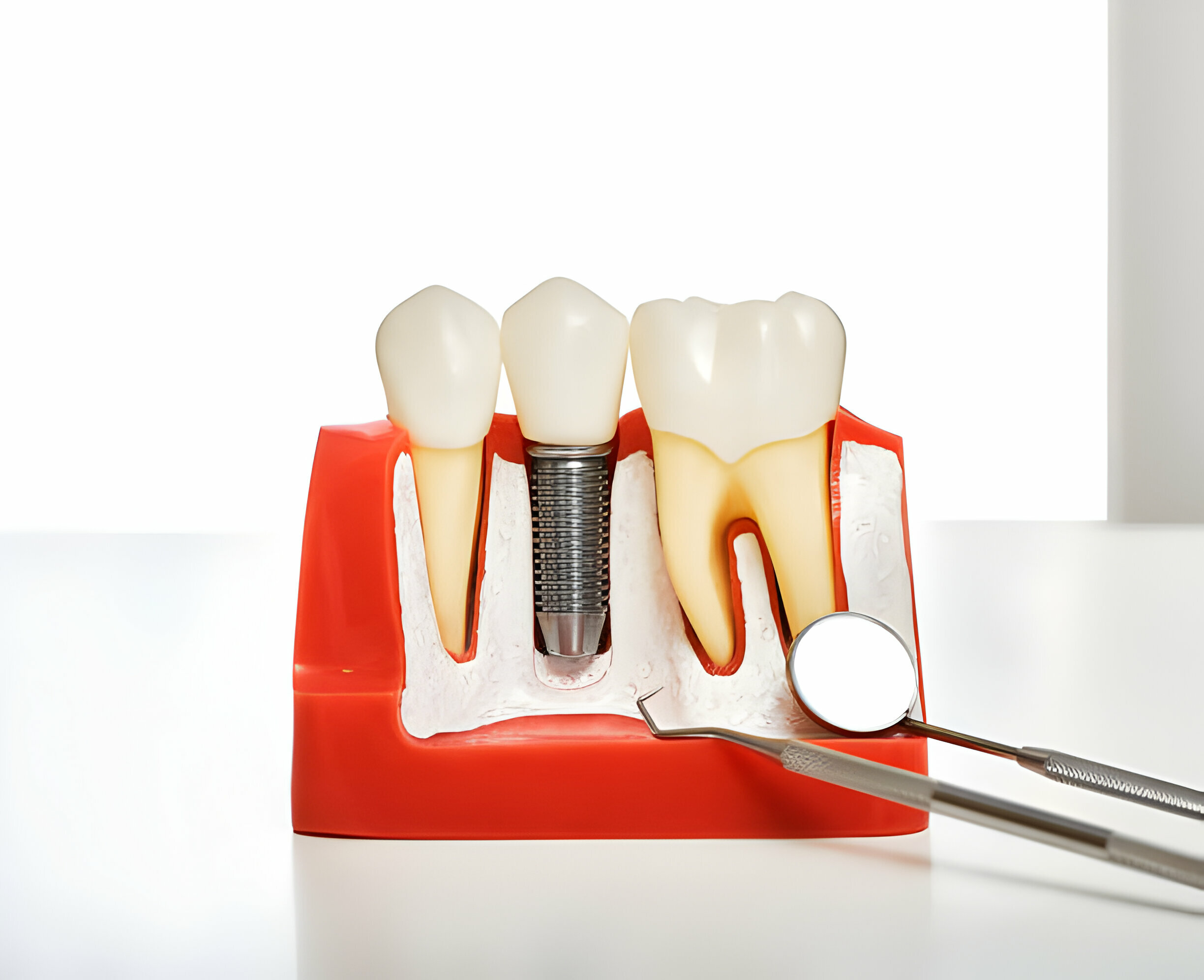Know Everything About Different Types of Dental Crowns_2