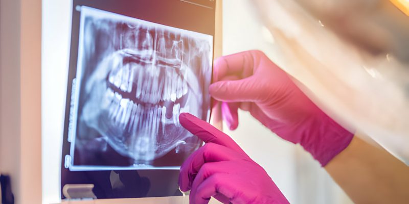 Different Types of X-Rays by Dental Summerville, SC_FI
