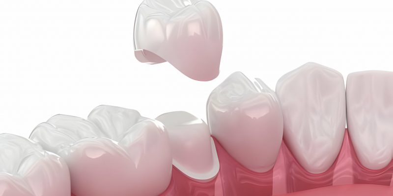 Know Everything About Different Types of Dental Crowns_FI