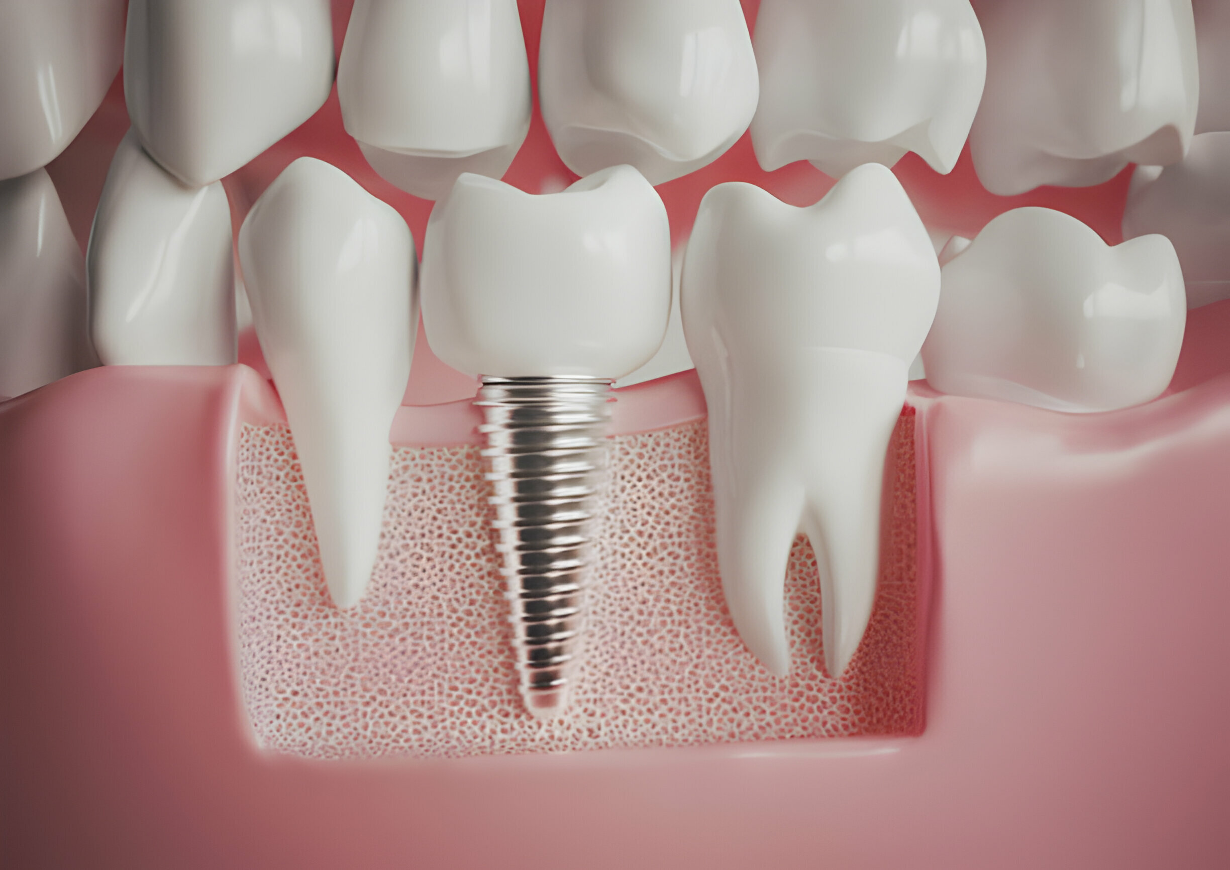 Everything You Need To Know About Dental Implants In Summerville_1