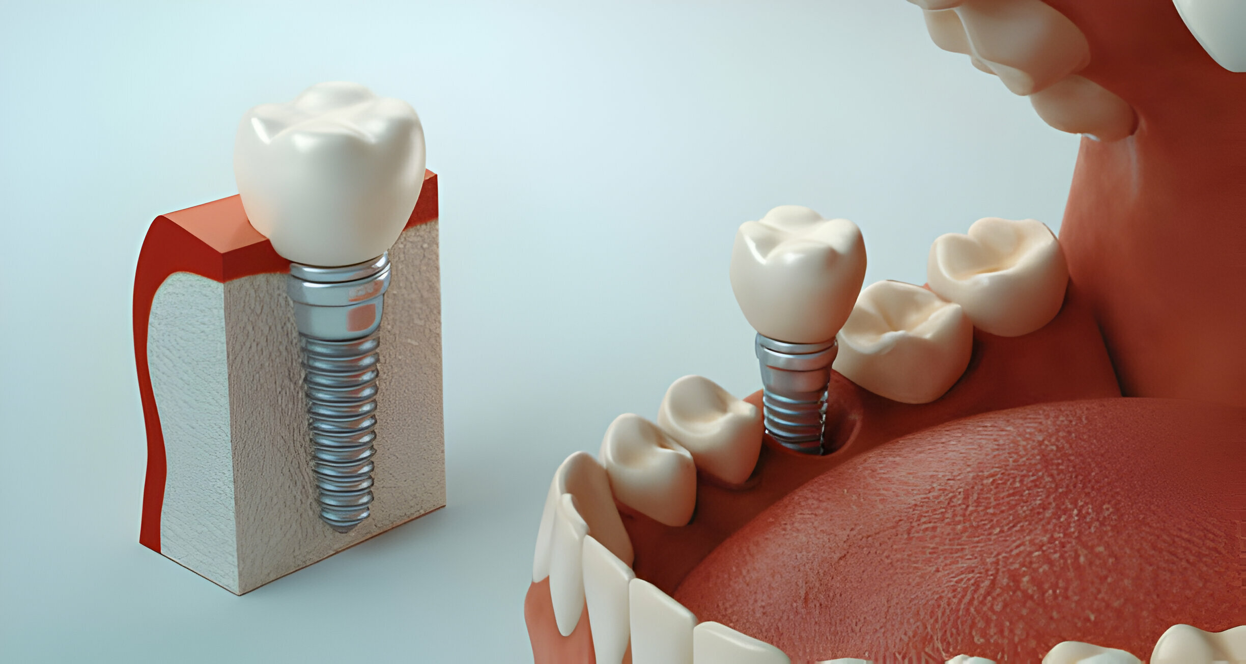 Everything You Need To Know About Dental Implants In Summerville_3