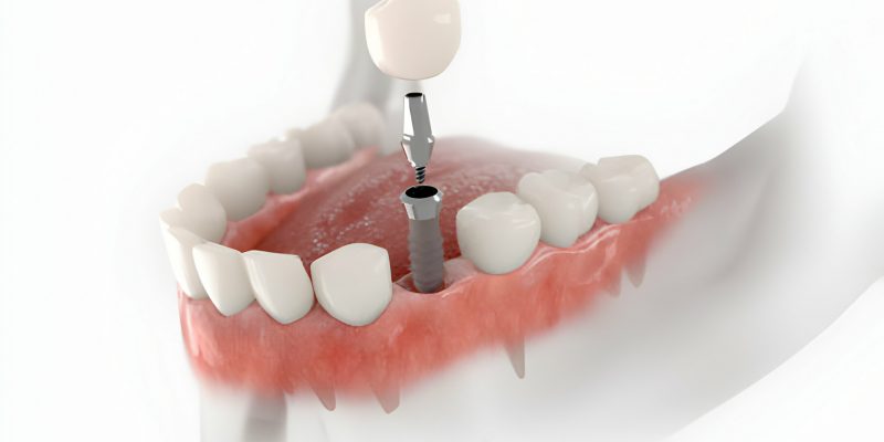 Everything You Need To Know About Dental Implants In Summerville_FI
