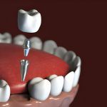 How Dental Implants Can Boost Your Confidence and Quality Of Life?_FI