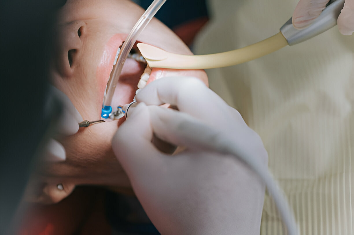 Why Choose Cane Bay Family Dentistry for Root Canal Therapy in Summerville, SC?_1