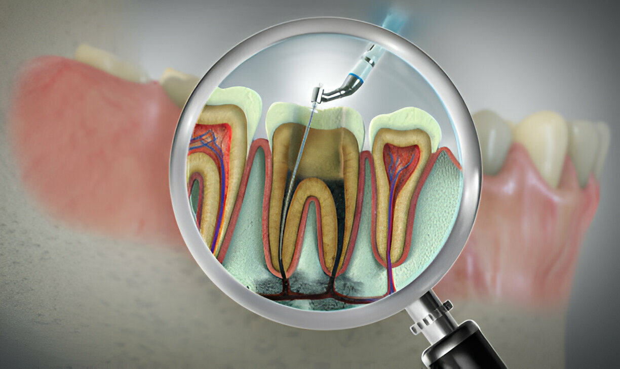 Why Choose Cane Bay Family Dentistry for Root Canal Therapy in Summerville, SC?_2