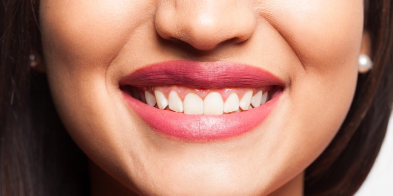 Professional Teeth Whitening in Summerville, SC – Why Patients Trust Cane Bay Family Dentistry_FI