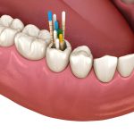 Why Summerville Patients Trust Cane Bay Family Dentistry for Root Canal Therapy_FI