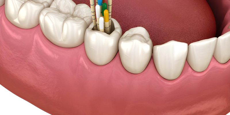 Why Summerville Patients Trust Cane Bay Family Dentistry for Root Canal Therapy_FI